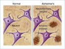 Image of amyloid plaques and ...